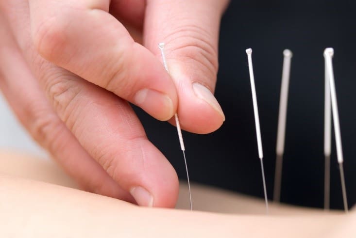 A person is using acupuncture needles to treat an illness.